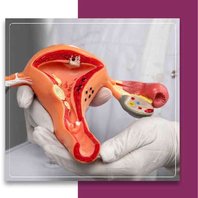 Types of Cervical Cancer
