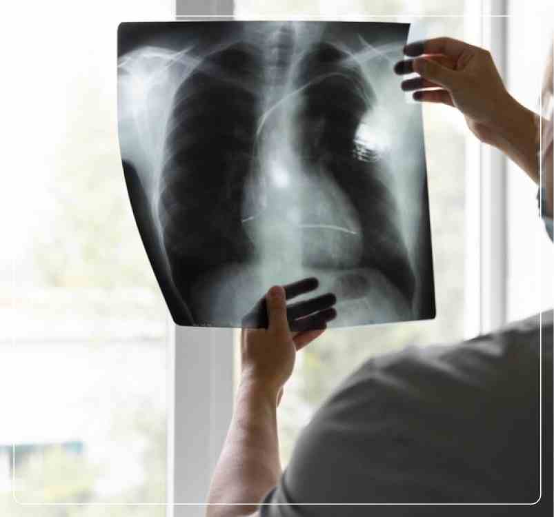 Stages of Lung Cancer