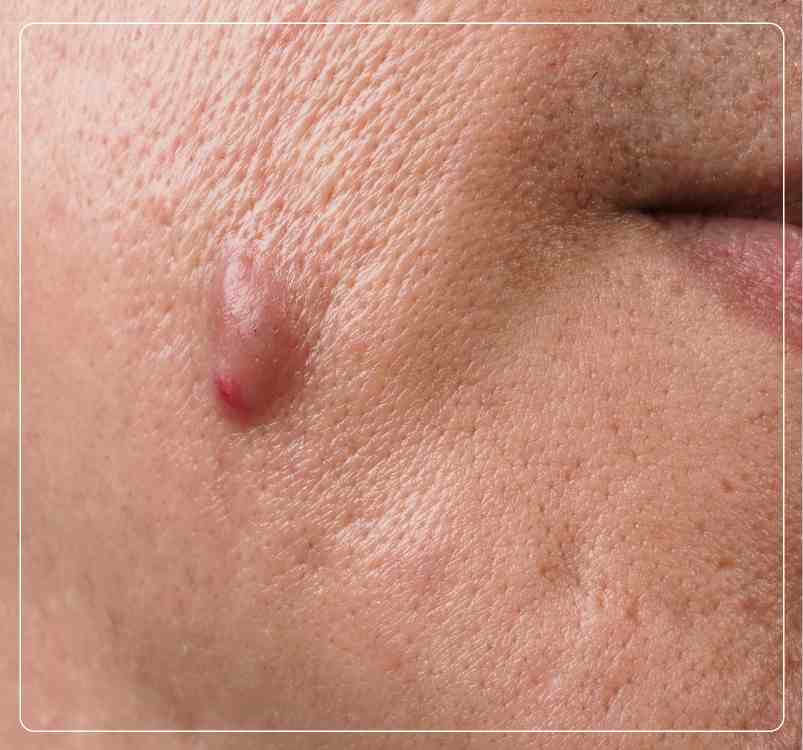Cheek Cancer Preventions