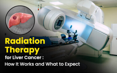 Radiation Therapy for Liver Cancer: How It Works and What to Expect