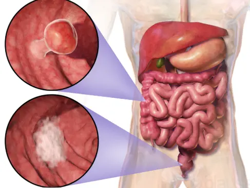 Colon Cancer