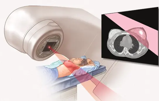 Radiation Therapy After Lumpectomy
