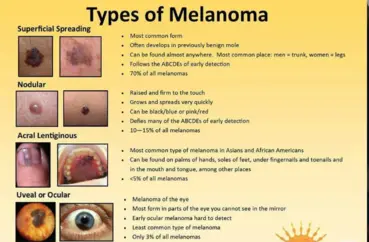 types of Melanoma