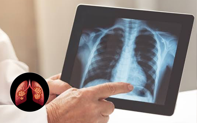 lung cancer